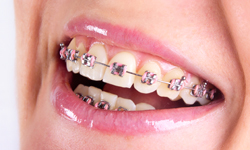 Types of Braces - Carolina Orthodontics and Pediatric Dentistry